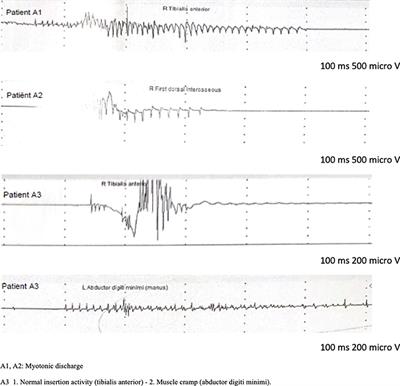 Case report: Coexistence of myotonia congenita and Brugada syndrome in one family